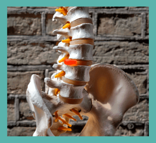 Fysiotherapie bij herniaklachten